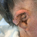Mohs Ear Patient 09 Thumbnail After