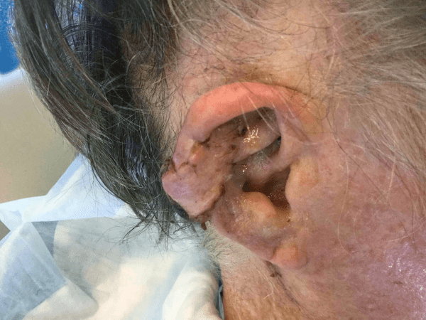 Mohs Ear Patient 09 After