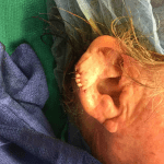 Mohs Ear Patient 09 Thumbnail Before - 2