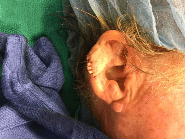 Mohs Ear Patient 09 Before - 2