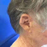 Mohs Ear Patient 09 Thumbnail After - 2