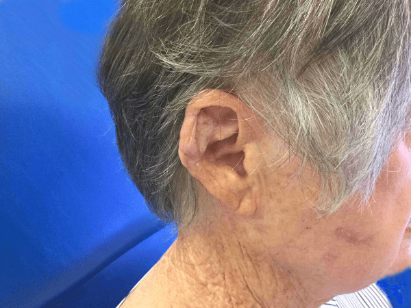 Mohs Ear Patient 09 After - 2