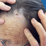 Mohs Face Patient 12 Thumbnail Before