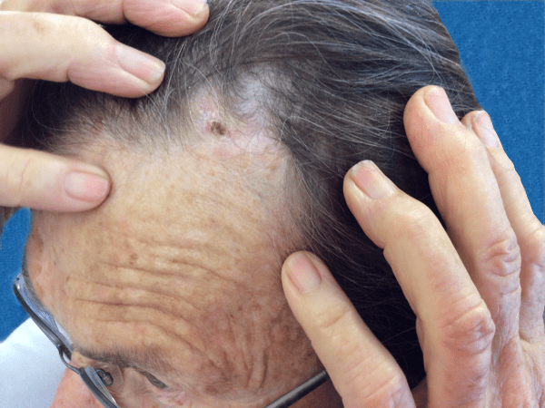 Mohs Face Patient 12 Before