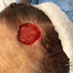 Mohs Face Patient 12 Thumbnail After