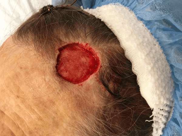 Mohs Face Patient 12 After