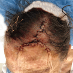 Mohs Face Patient 12 Thumbnail Before - 2