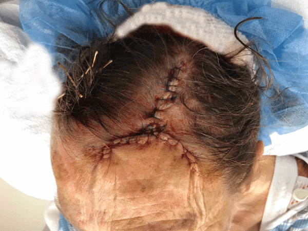 Mohs Face Patient 12 Before - 2