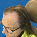 Mohs Face Patient 12 Thumbnail After - 2