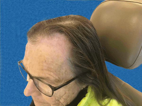 Mohs Face Patient 12 After - 2