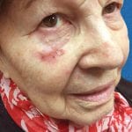 Mohs Face Patient 13 Thumbnail Before