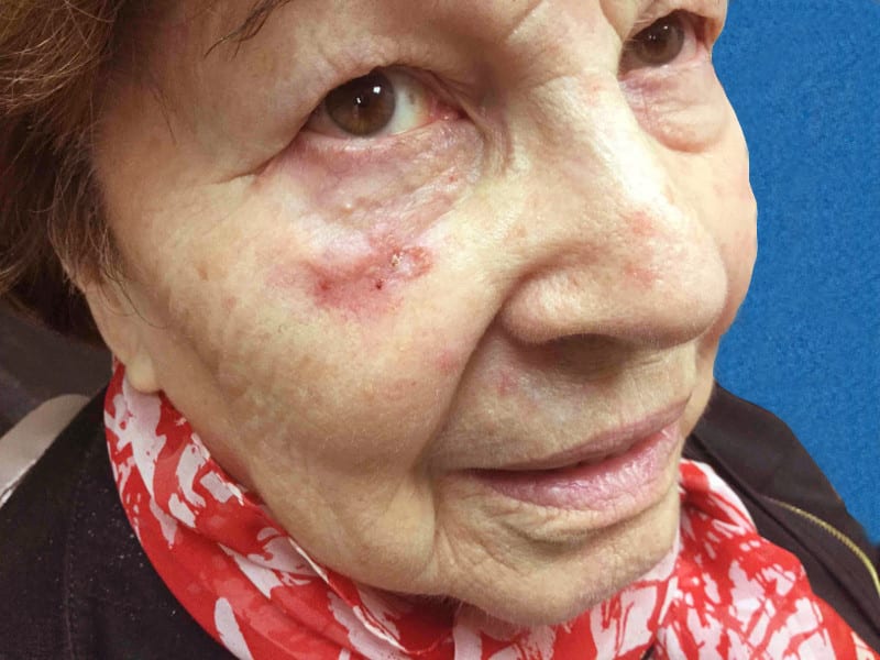 Mohs Face Patient 13 Before