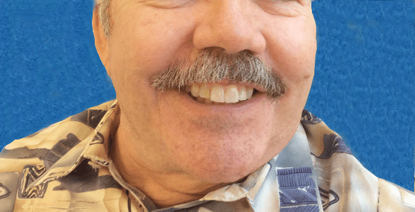 Mohs Lip Patient 09 Before