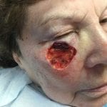 Mohs Face Patient 13 Thumbnail After