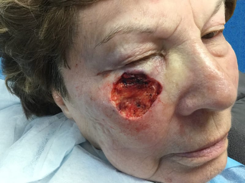 Mohs Face Patient 13 After