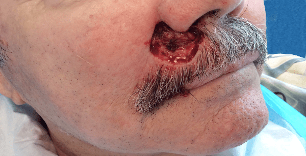 Mohs Lip Patient 09 After