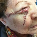 Mohs Face Patient 13 Thumbnail Before - 2