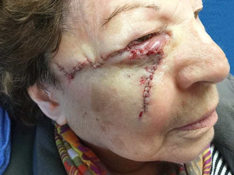 Mohs Face Patient 13 Before - 2