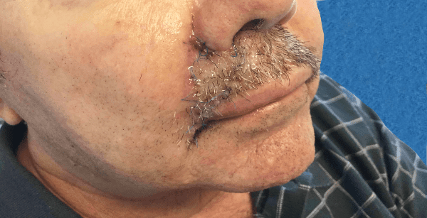 Mohs Lip Patient 09 Before - 2