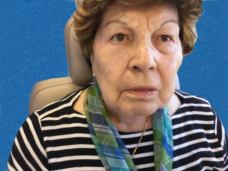 Mohs Face Patient 13 After - 2