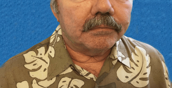 Mohs Lip Patient 09 After - 2