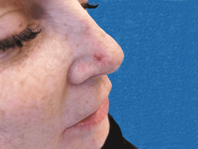 Nose Pasadena Newport Beach Dr Hung