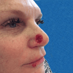 Mohs Nose Patient 22 Thumbnail After