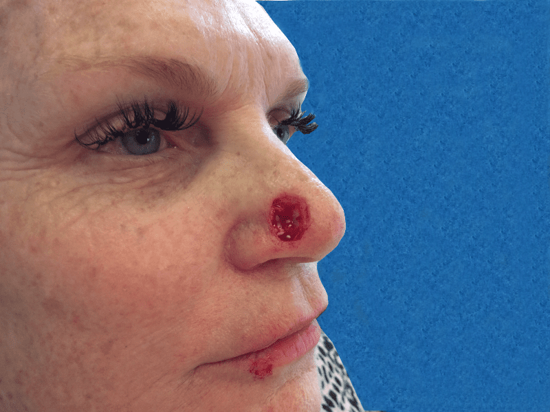 Nose - Pasadena &amp; Newport Beach | Dr. Hung