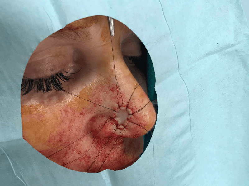 Mohs Nose Patient 22 Before - 2