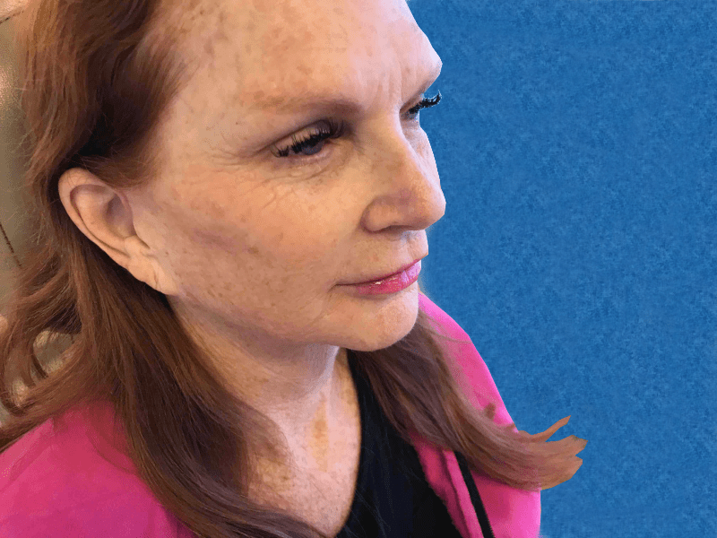 Mohs Nose Patient 22 After - 2