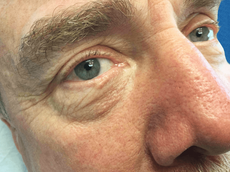 Mohs Eye Patient 05 Before