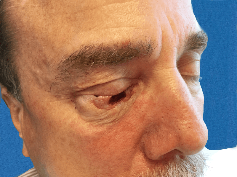 Mohs Eye Patient 05 After