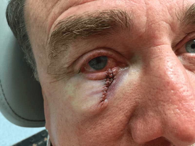 Mohs Eye Patient 05 Before - 2