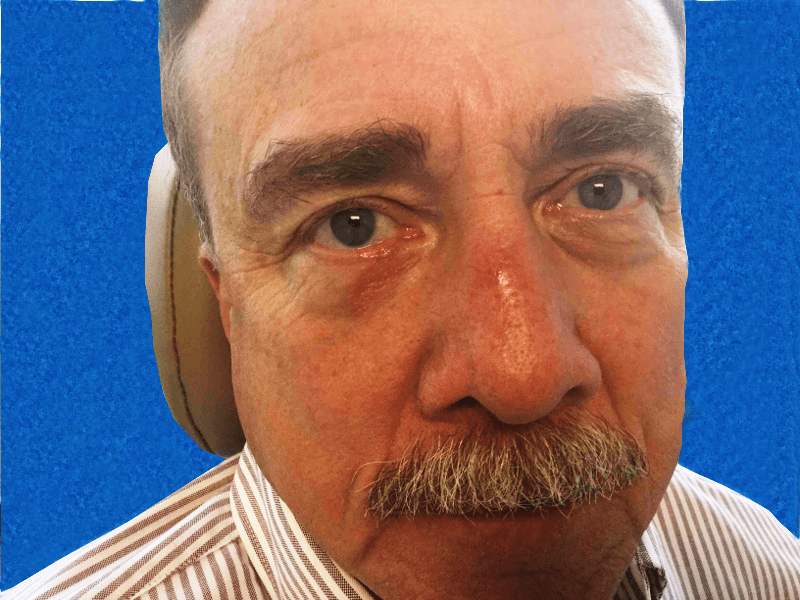 Mohs Eye Patient 05 After - 2