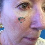 Mohs Face Patient 15 Thumbnail Before