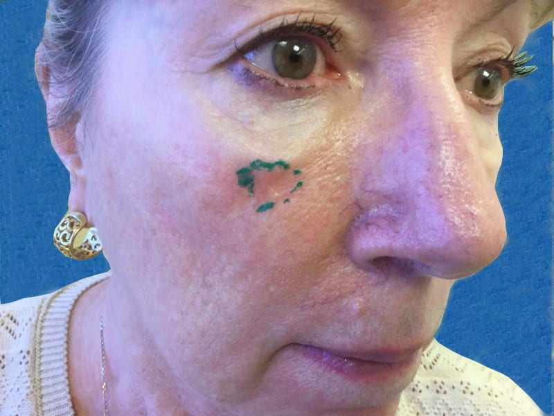 Mohs Face Patient 15 Before