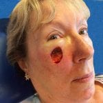 Mohs Face Patient 15 Thumbnail After