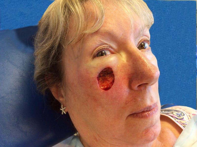 Mohs Face Patient 15 After