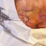 Mohs Face Patient 15 Thumbnail Before - 2