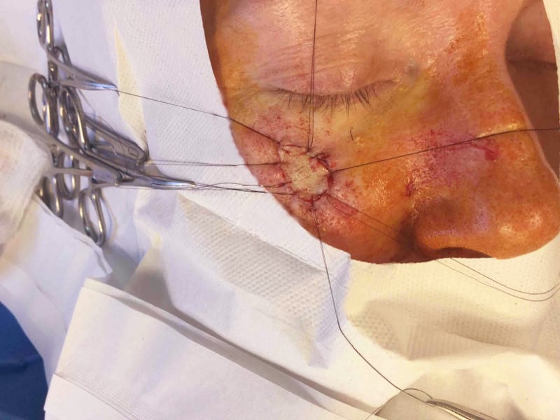 Mohs Face Patient 15 Before - 2