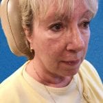 Mohs Face Patient 15 Thumbnail After - 2