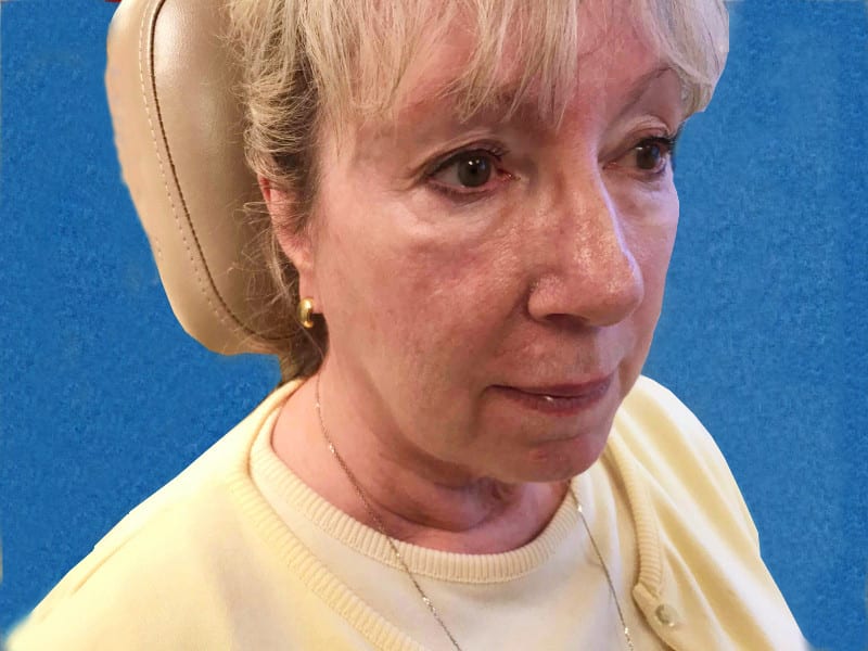 Mohs Face Patient 15 After - 2