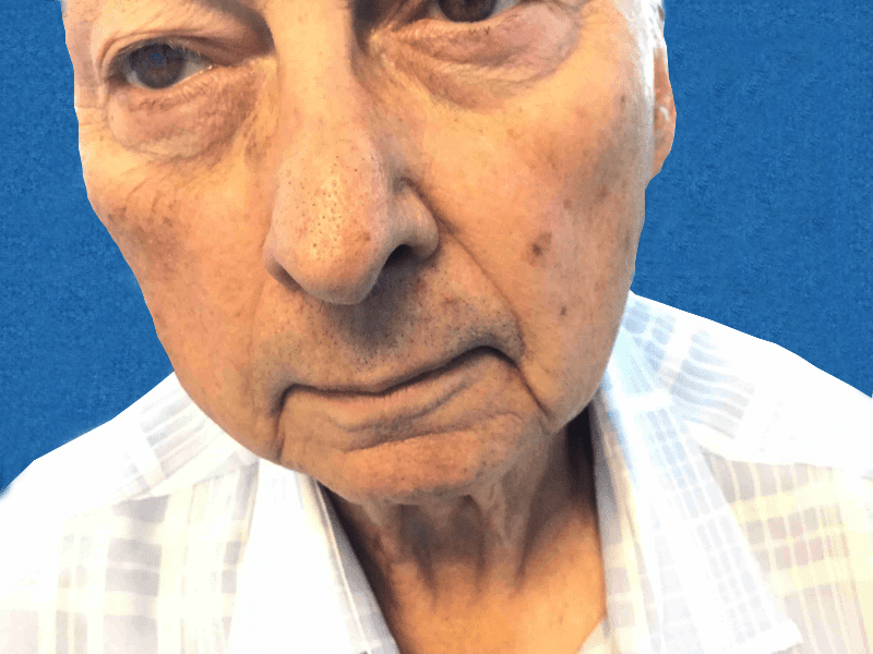 Mohs Lip Patient 10 Before