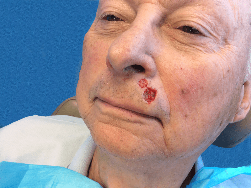 Mohs Lip Patient 10 After