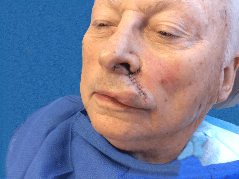 Mohs Lip Patient 10 Before - 2