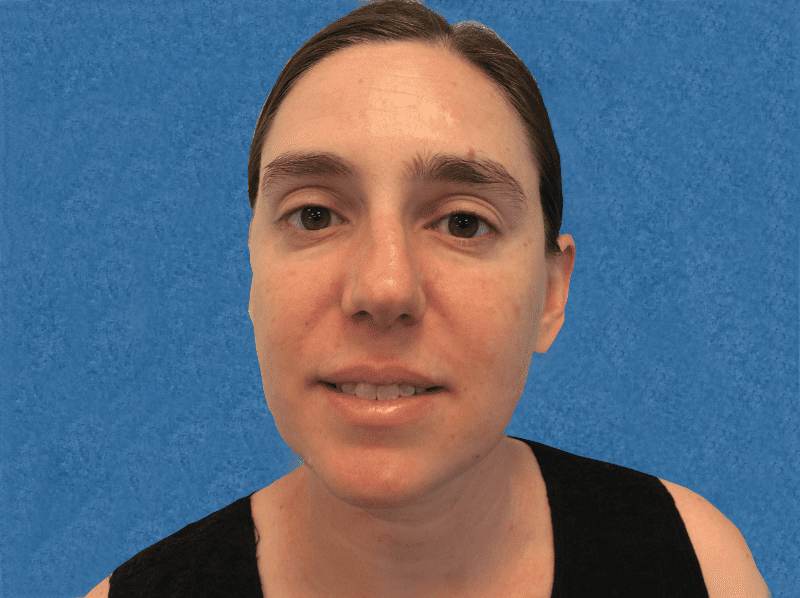 Mohs Lip Patient 12 Before