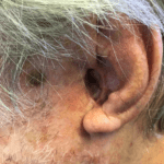 Mohs Ear Patient 10 Thumbnail Before