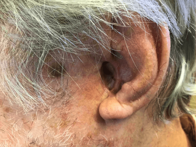 Mohs Ear Patient 10 Before