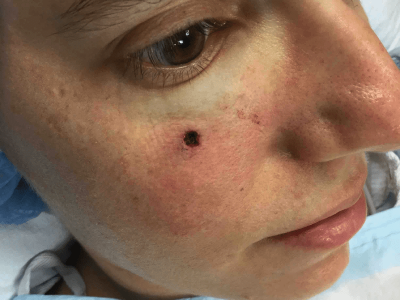 Mohs Face Patient 17 After