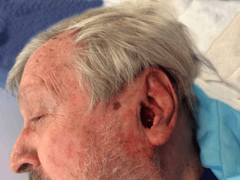 Mohs Ear Patient 10 After